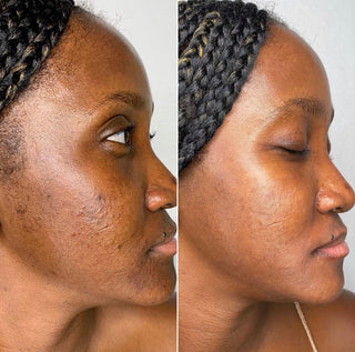 HYPERPIGMENTATION CORRECTOR